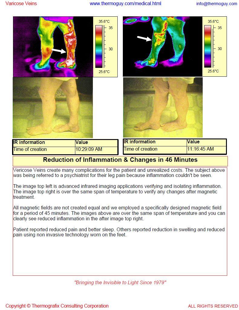 Varicose Veins