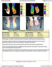 Diabetic Neuropathy