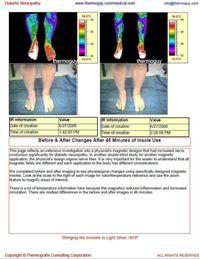 Diabetic Neuropathy 2