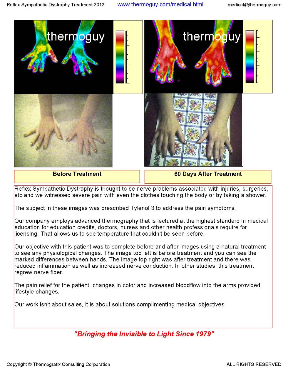 Reflex Sympathetic Dystrophy