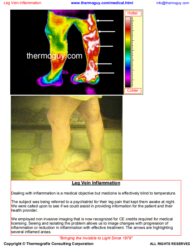Leg Vein Inflamation