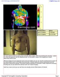 Acute Pancreatitis