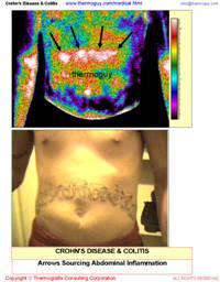 Chrohn's Disease, Colitis  or Inflammatory Bowel