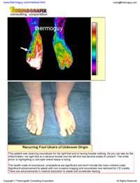Recurring Foot Ulcers