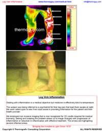 Leg Vein Inflammation