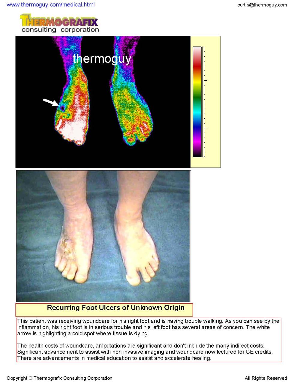 Foot Ulcers