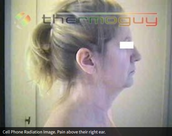 Cell Phone Radiation Image. Pain above their right ear.