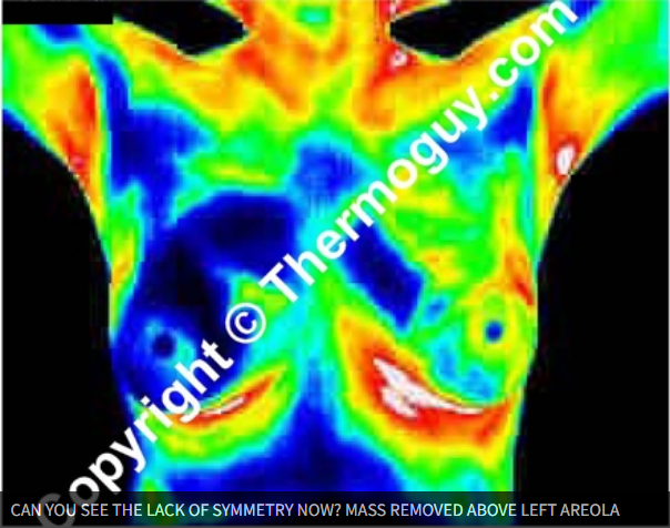 Can You See The Lack of Symmetry Now? Mass Removed Above Left Areola