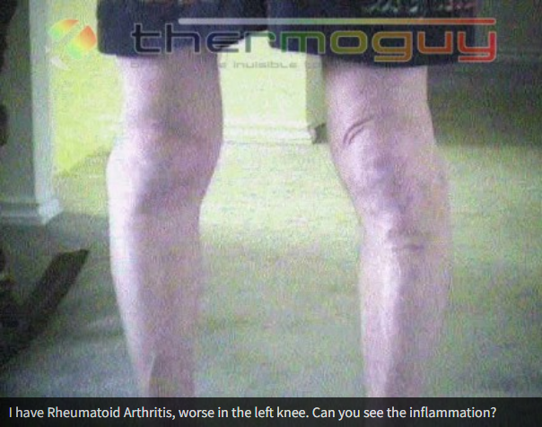 I have Rheumatoid Arthritis, worse in the left knee. Can you see the inflammation?