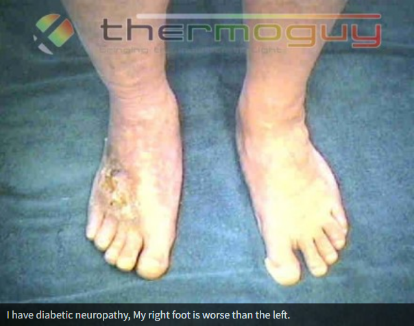 I have diabetic neuropathy. My right foot is worse than the left.