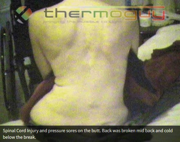 Spinal Cord Injury and pressure sores on the butt. Back was broken mid back and cold below the break.