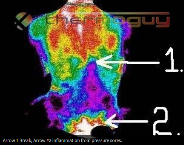 Arrow #1 Break, Arrow #2 inflammation from pressure sores.