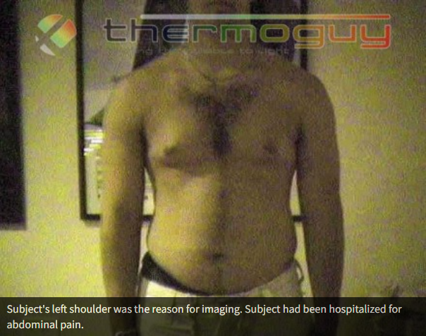 Subject's left shoulder was the reason for imaging. Subject had been hospitalized for abdominal pain.