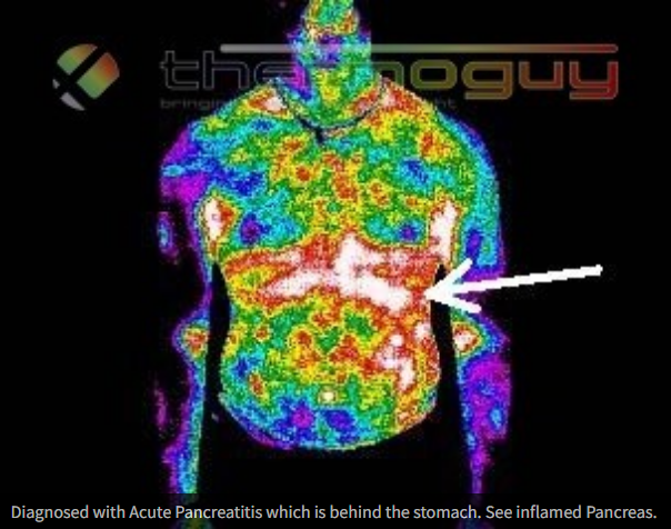 Diagnosed with Acute Pancreatitis which is behind the stomach. See inflamed Pancreas.