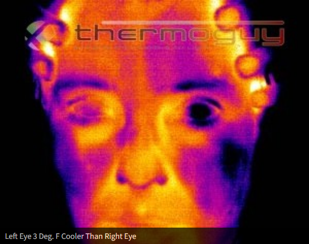 Left Eye 3 Deg. F Cooler Than Right Eye