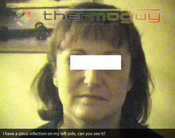 I have a sinus infection on my left side; can you see it?