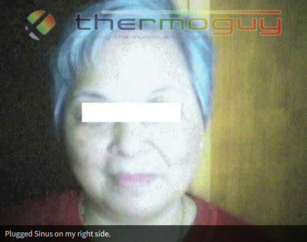 Plugged Sinus on my right side.