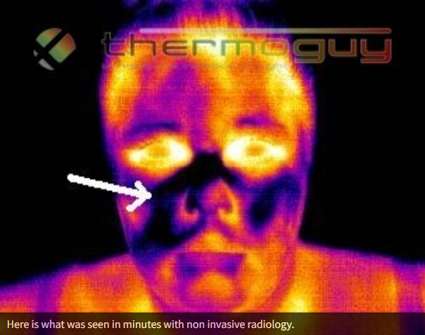 Here is what was seen in minutes with non invasive radiology.