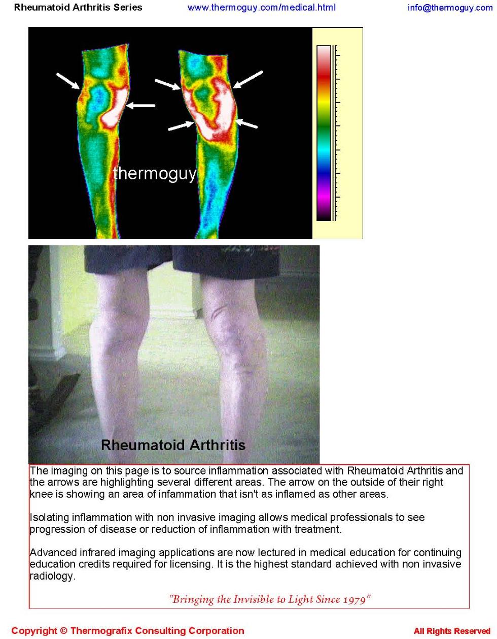 Rheumatoid Arthritis